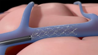 Picture of Stent-electrode recording array