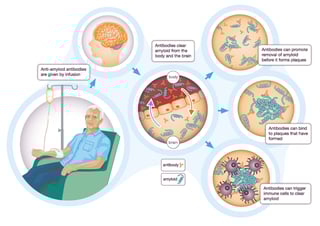 Picture of Donanemab