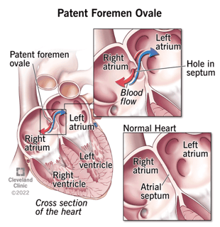Picture of patent foramen ovale