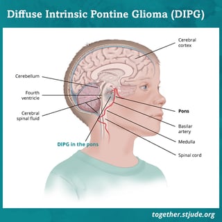 Picture of Diffuse intrinsic pontine glioma