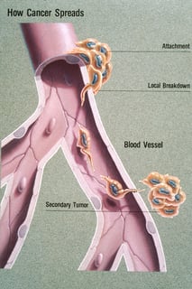 Picture of Metastasis