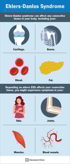 Picture of Ehlers–Danlos syndrome