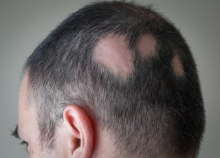 Picture of alopecia areata