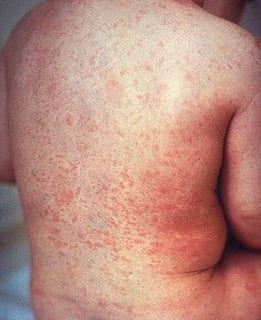 Picture of rubella