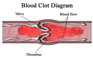 Picture of Thrombus