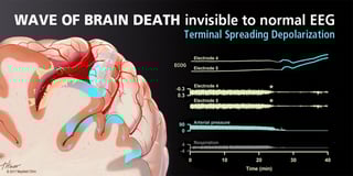 Picture of brain death