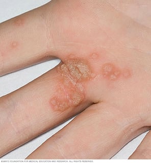 Picture of Human papillomavirus infection