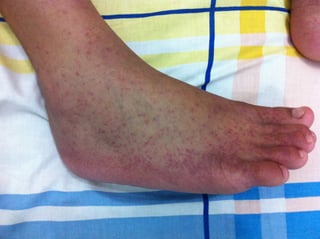 Picture of chikungunya
