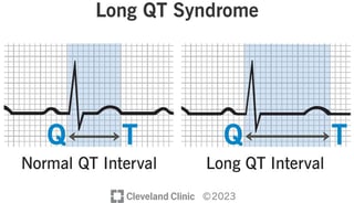 Picture of long QT syndrome