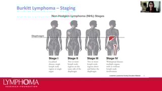 Picture of Burkitt lymphoma