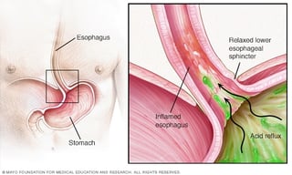 Picture of gastroesophageal reflux disease
