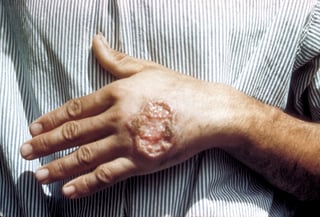 Picture of leishmaniasis