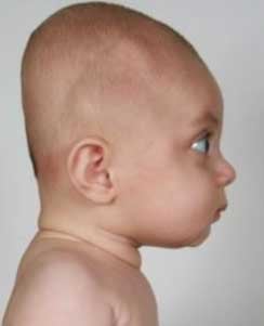 Picture of brachycephaly