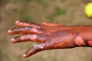 Picture of burn