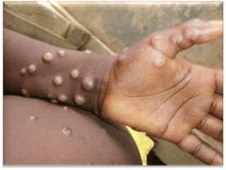 Picture of Mpox