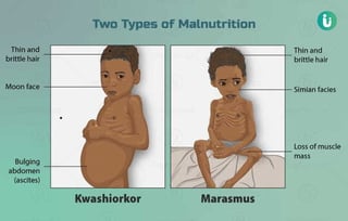Picture of malnutrition