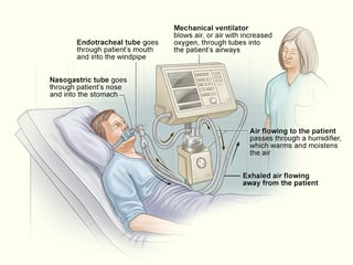 Picture of Ventilator