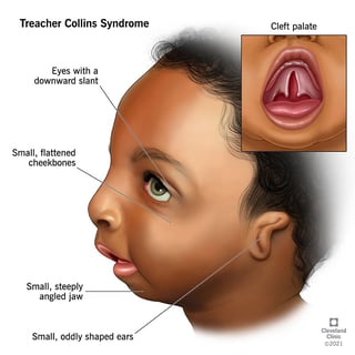 Picture of Syndrome