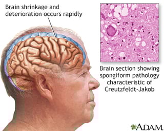 Picture of Creutzfeldt-Jakob disease