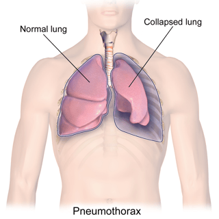 Picture of pneumothorax