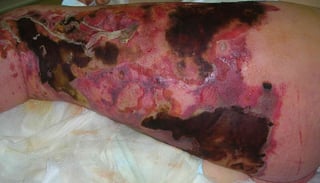 Picture of necrotizing fasciitis
