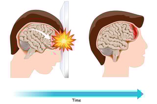 Picture of brain damage