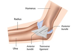 Picture of Ulnar collateral ligament reconstruction