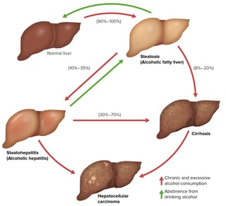 Picture of alcoholic liver disease