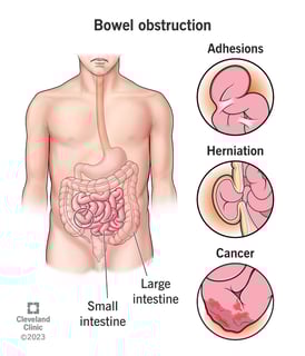 Picture of Bowel obstruction