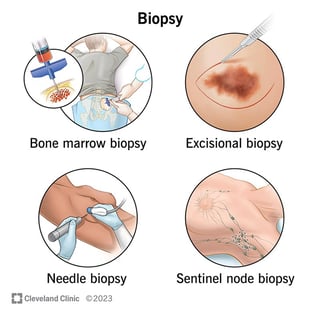 Picture of Biopsy