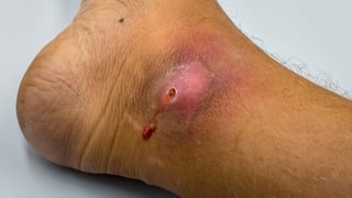 Picture of wound