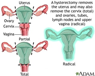 Picture of Hysterectomy