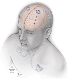Picture of Deep brain stimulation