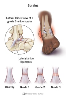 Picture of sprain