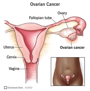 Picture of ovarian cancer