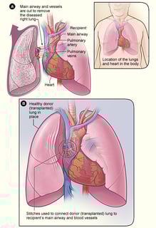 Picture of Lung transplantation