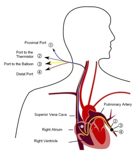 Picture of Pulmonary wedge pressure
