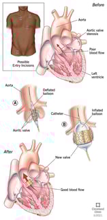 Picture of Percutaneous aortic valve replacement