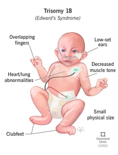 Picture of Edwards syndrome‎