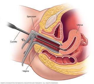 Picture of Dilation and curettage