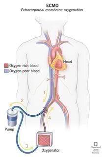 Picture of Extracorporeal membrane oxygenation