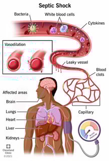 Picture of septic shock
