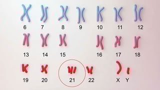 Picture of Down syndrome