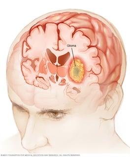 Picture of glioma