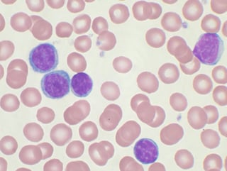 Picture of chronic lymphocytic leukemia