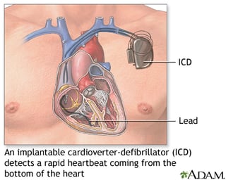 Picture of Implantable cardioverter-defibrillator