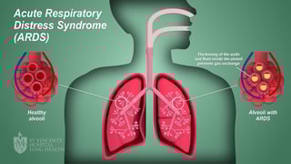 Picture of acute respiratory distress syndrome
