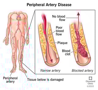 Picture of Peripheral artery disease