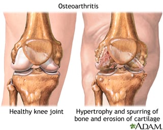 Picture of osteoarthritis