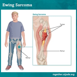 Picture of Ewing sarcoma